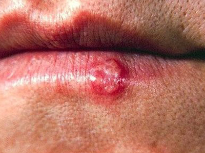 Επιχείλιος έρπης